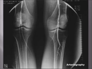 1- Laboratory investigations:
2- Imaging:
- Doppler flow study.
• ABI
• Segmental pressure
- Duplex scanning
- Arteriography
Arteriography
 