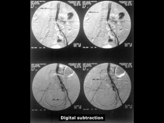 Digital subtraction
 