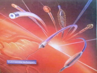 Endovascular techniques
 