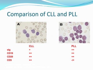 Comparison of CLL and PLL
B-CLL

CLL-PLL

CLL
slg
CD19
CD20
CD5

PLL

+
++
++
++

++
++
++
-/+

Courtesy of Randy Gascoyne, MD.
1. Bennett JM, et al. J Clin Pathol. 1989;42:567-584.

 