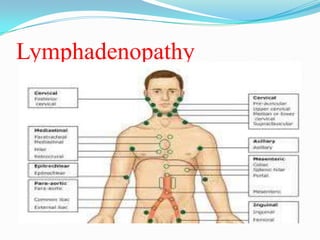 Lymphadenopathy

 
