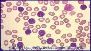 Chronic lymphocytic leukemia | PPTX