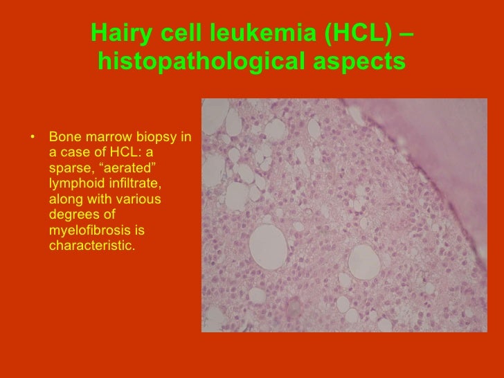 hairy cell leukemia case study Unusual presentation of hairy cell leukemia: a case series of four clinically unsuspected cases this is an observational study conducted between january. hairy cell leukemia case study Unusual presentation of hairy cell leukemia: a case series of four clinically unsuspected cases this is an observational study conducted between january.