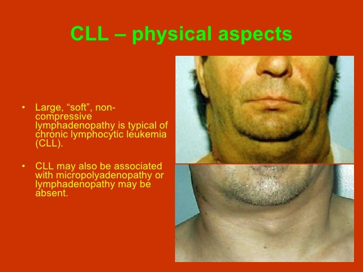Chronic Lymphocytic Leukemia And Hairy Cell Leukemia