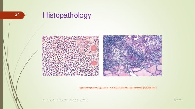 Chronic Lymphocytic Thyroiditis hashimoto Thyroiditis Autoimmune
