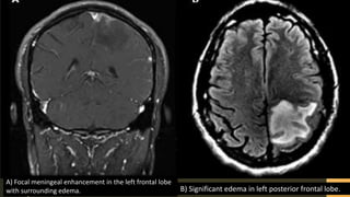 z
B) Significant edema in left posterior frontal lobe.
A) Focal meningeal enhancement in the left frontal lobe
with surrounding edema.
 