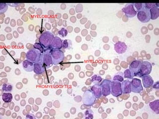 MYELOBLAST
BAND CELLS
PROMYELOCYTES
MYELOCYTES
 