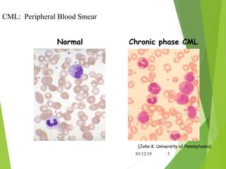 (John K. University of Pennsylvania)
Normal Chronic phase CML
CML: Peripheral Blood Smear
01/12/15 5
 