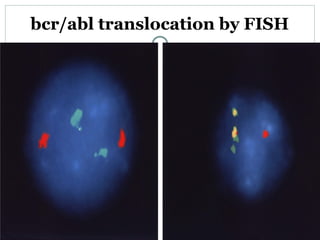 Chronic Myeloid Leukaemia | PPT | Blood Disorders | Diseases and Conditions