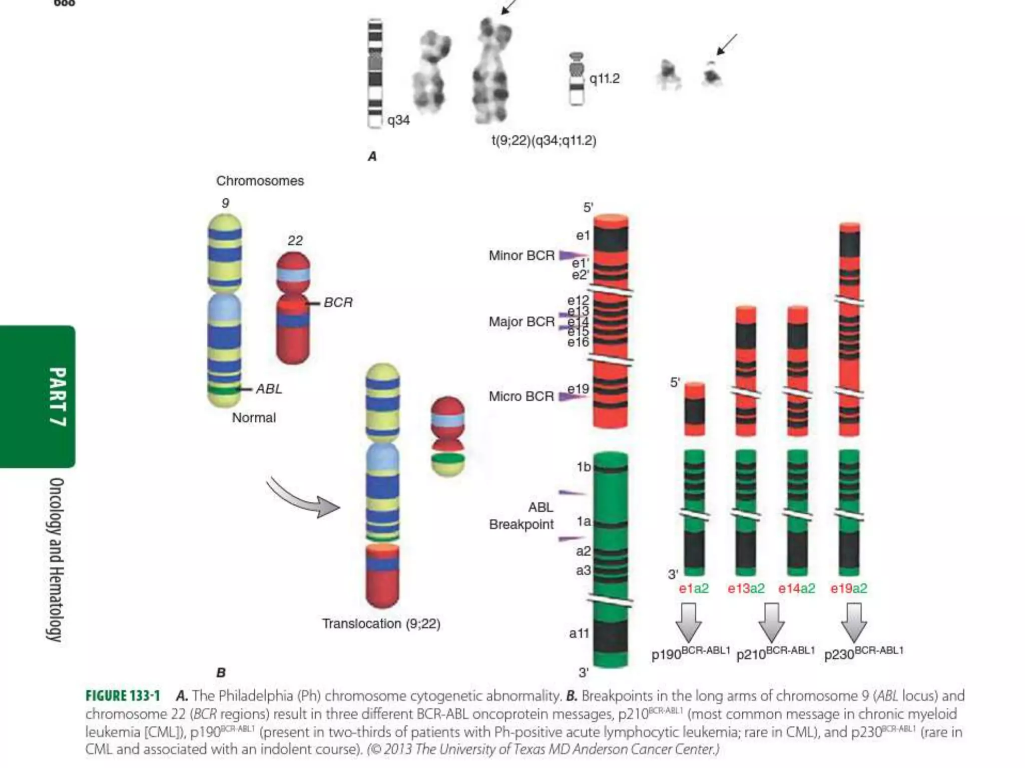 Chronic myeloid leukemia | PPTX