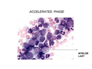 Chronic Myeloid Leukaemia | PPT