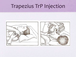 Trap Injection Chronic myofascial pain | PPTX