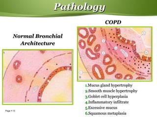 Page  13
PathologyPathology
1.1.Mucus gland hypertrophyMucus gland hypertrophy
2.2.Smooth muscle hypertrophySmooth muscle hypertrophy
3.3.Goblet cell hyperplasiaGoblet cell hyperplasia
4.4.Inflammatory infiltrateInflammatory infiltrate
5.5.Excessive mucusExcessive mucus
6.6.Squamous metaplasiaSquamous metaplasia
Normal BronchialNormal Bronchial
ArchitectureArchitecture
COPDCOPD
 