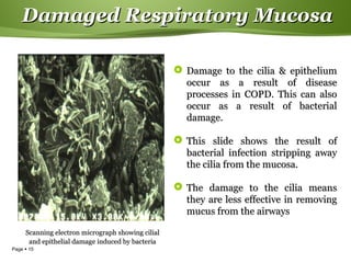 Page  15
Damaged Respiratory MucosaDamaged Respiratory Mucosa
 Damage to the cilia & epitheliumDamage to the cilia & epithelium
occur as a result of diseaseoccur as a result of disease
processes in COPD. This can alsoprocesses in COPD. This can also
occur as a result of bacterialoccur as a result of bacterial
damage.damage.
 This slide shows the result ofThis slide shows the result of
bacterial infection stripping awaybacterial infection stripping away
the cilia from the mucosa.the cilia from the mucosa.
 The damage to the cilia meansThe damage to the cilia means
they are less effective in removingthey are less effective in removing
mucus from the airwaysmucus from the airways
Scanning electron micrograph showing cilialScanning electron micrograph showing cilial
and epithelial damage induced by bacteriaand epithelial damage induced by bacteria
 