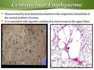 Page  16
Centriacinar EmphysemaCentriacinar Emphysema
 Characterized by focal destruction limited to the respiratory bronchioles &Characterized by focal destruction limited to the respiratory bronchioles &
the central portions of acinus.the central portions of acinus.
 Is is associated with cigarette smoking & is most severe in the upper lobes.Is is associated with cigarette smoking & is most severe in the upper lobes.
 