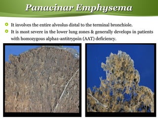 Page  17
Panacinar EmphysemaPanacinar Emphysema
 It involves the entire alveolus distal to the terminal bronchiole.It involves the entire alveolus distal to the terminal bronchiole.
 It is most severe in the lower lung zones & generally develops in patientsIt is most severe in the lower lung zones & generally develops in patients
with homozygous alpha1-antitrypsin (AAT) deficiency.with homozygous alpha1-antitrypsin (AAT) deficiency.
 