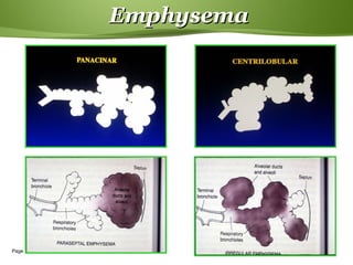 Page  19
EmphysemaEmphysema
 