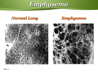 Page  21
EmphysemaEmphysema
EmphysemaEmphysemaNormal LungNormal Lung
 