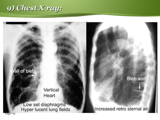 Page  34
9) Chest X ray:9) Chest X ray:
 