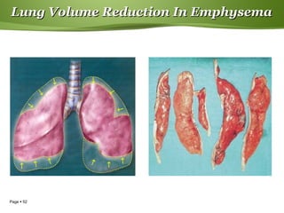 Page  52
Lung Volume Reduction In EmphysemaLung Volume Reduction In Emphysema
↓
↓
↑
↑
↑
↑
↓
↑ ↑
↓ ↓
↓
 