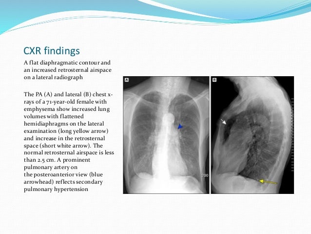 Chronic obstructive pulmonary disease