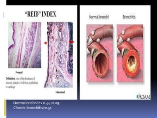 Normal reid index 0.44±0.09
Chronic bronchitis>0.51
 