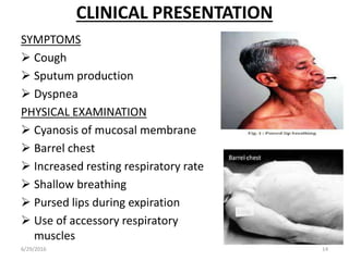 CLINICAL PRESENTATION
SYMPTOMS
 Cough
 Sputum production
 Dyspnea
PHYSICAL EXAMINATION
 Cyanosis of mucosal membrane
 Barrel chest
 Increased resting respiratory rate
 Shallow breathing
 Pursed lips during expiration
 Use of accessory respiratory
muscles
6/29/2016 14
 