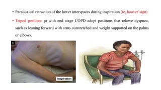 • Paradoxical retraction of the lower interspaces during inspiration (ie, hoover’sign)
• Tripod position- pt with end stage COPD adopt positions that relieve dyspnea,
such as leaning forward with arms outstretched and weight supported on the palms
or elbows.
 