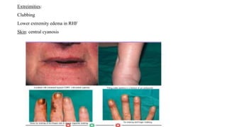 Extreimities:
Clubbing
Lower extremity edema in RHF
Skin: central cyanosis
 