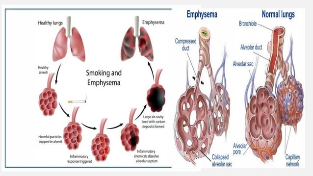 Chronic Obstructive Pulmonary Disease (COPD) Pathophysiology.pptx