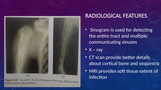 RADIOLOGICAL FEATURES
• Sinogram is used for detecting
the entire tract and multiple
communicating sinuses
• X – ray
• CT scan provide better details
about cortical bone and sequestra
• MRI provides soft tissue extent of
infection
 