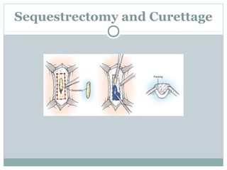 Sequestrectomy and Curettage
 