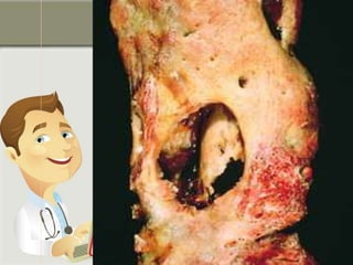 Chronic osteomyelitis