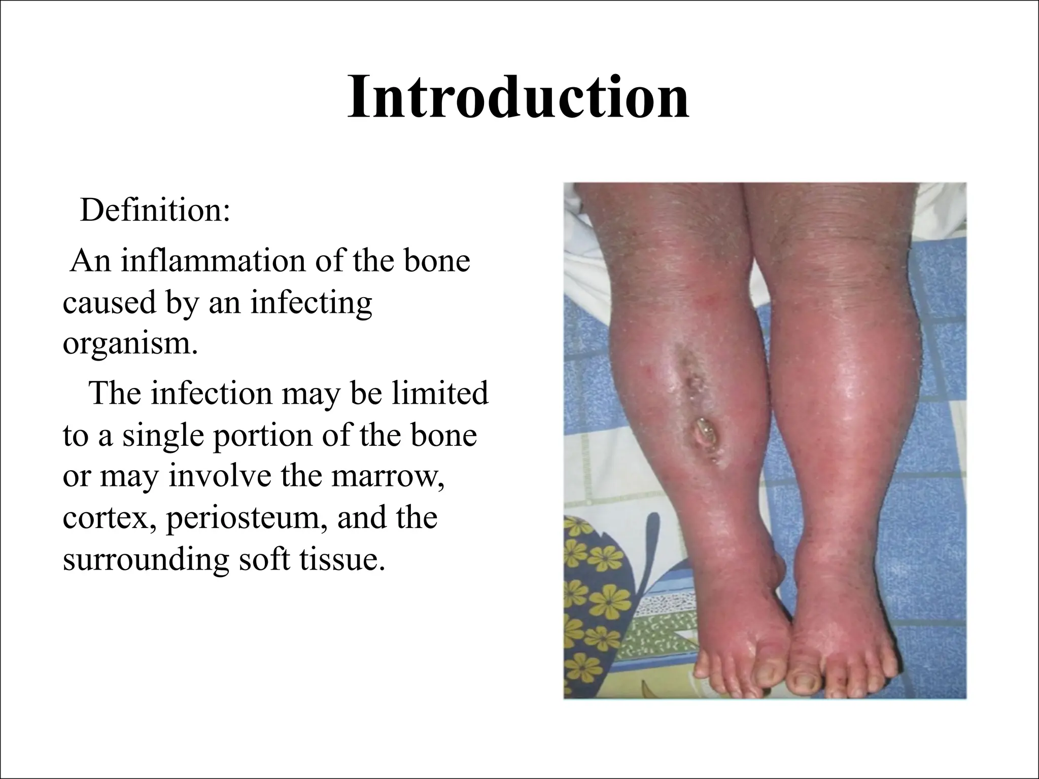 Chronic osteomy lllhhhhhhhhhhhhhhhhelitis (2).pdf