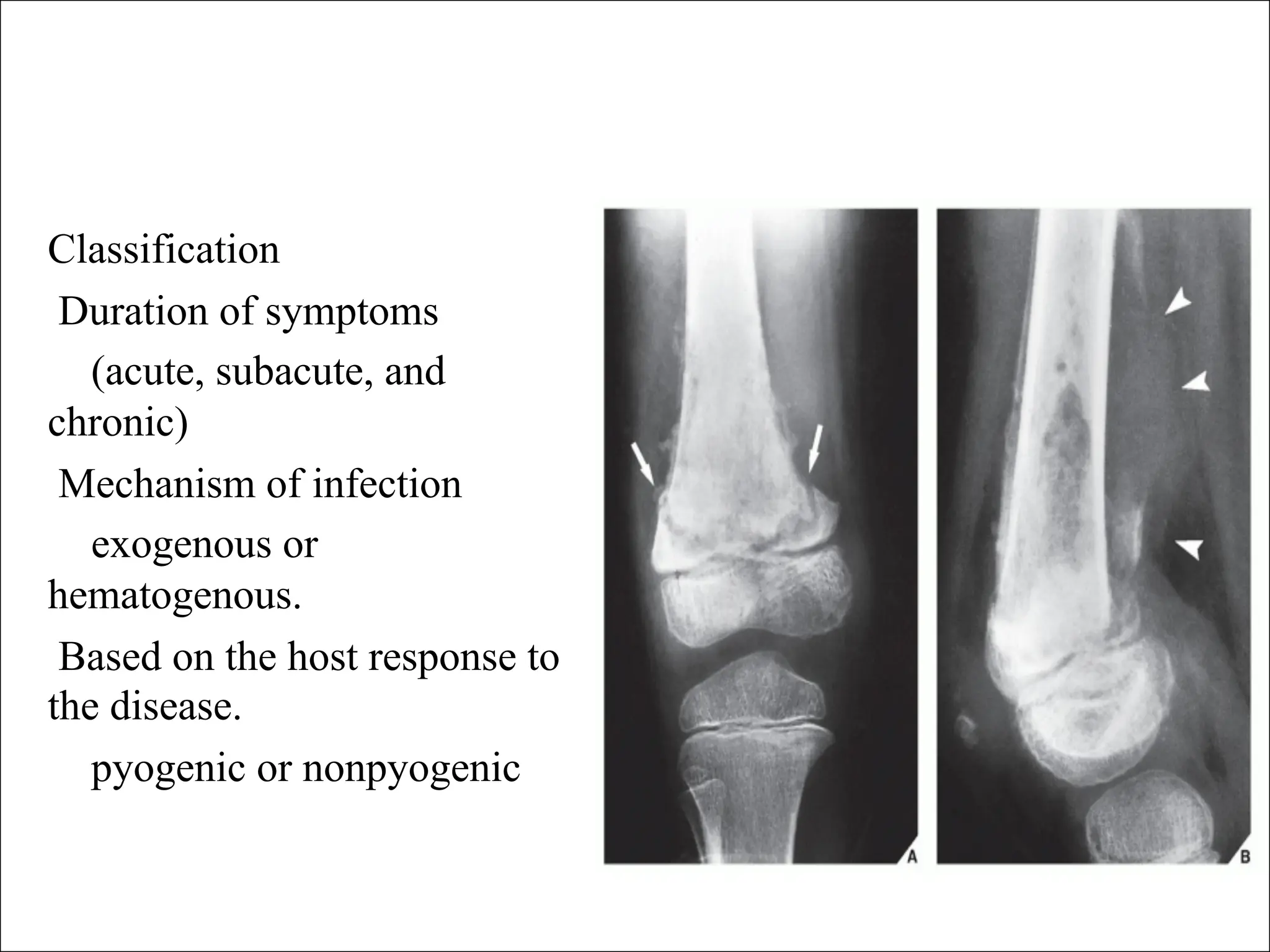 Chronic osteomy lllhhhhhhhhhhhhhhhhelitis (2).pdf