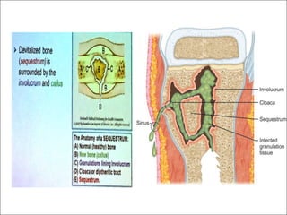 Chronic osteomy lllhhhhhhhhhhhhhhhhelitis (2).pdf