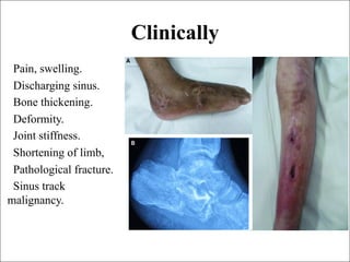Chronic osteomy lllhhhhhhhhhhhhhhhhelitis (2).pdf