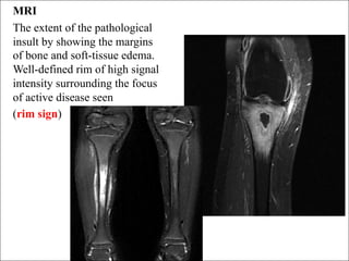 Chronic osteomy lllhhhhhhhhhhhhhhhhelitis (2).pdf