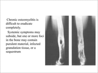 Chronic osteomy lllhhhhhhhhhhhhhhhhelitis (2).pdf
