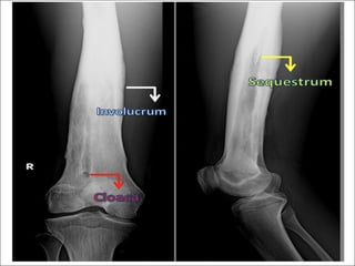 Chronic osteomy lllhhhhhhhhhhhhhhhhelitis (2).pdf