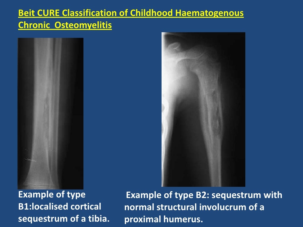 Chronic Osteomyelitis In Children