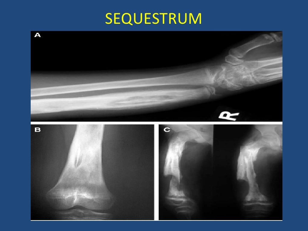 Chronic Osteomyelitis In Children