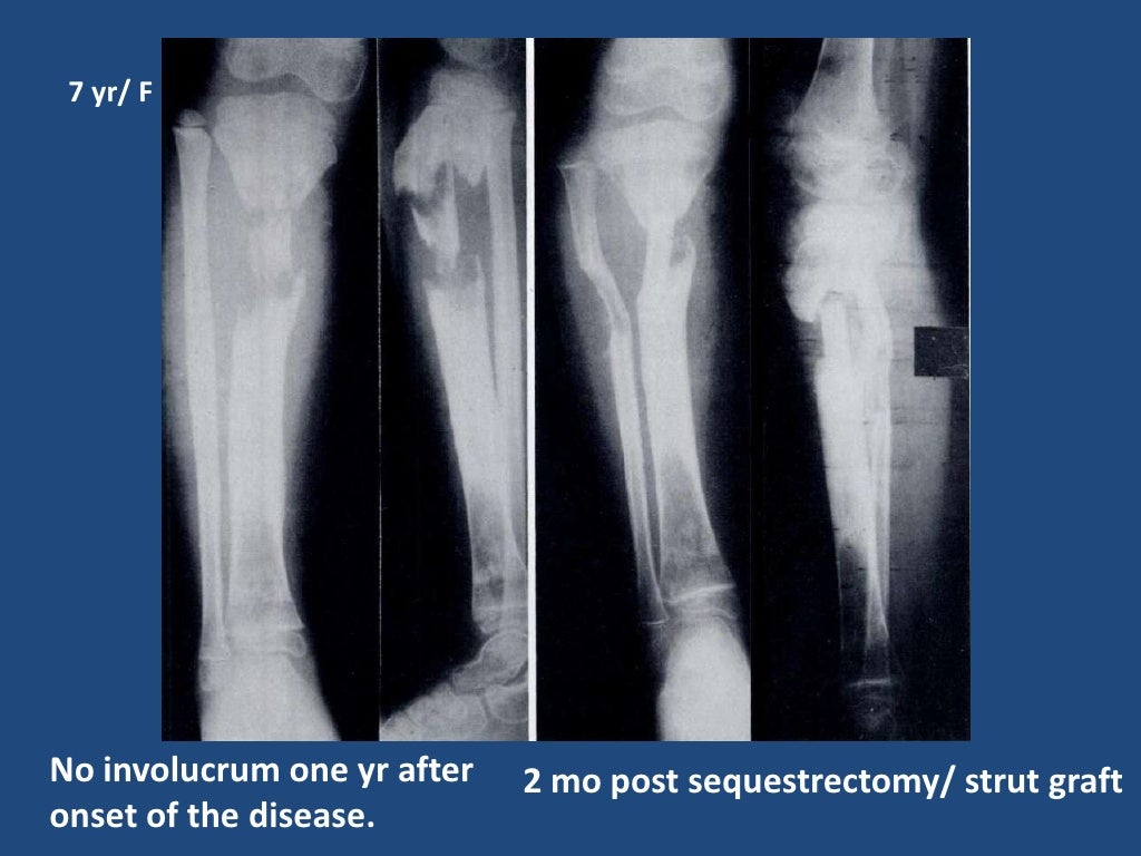 Chronic Osteomyelitis In Children