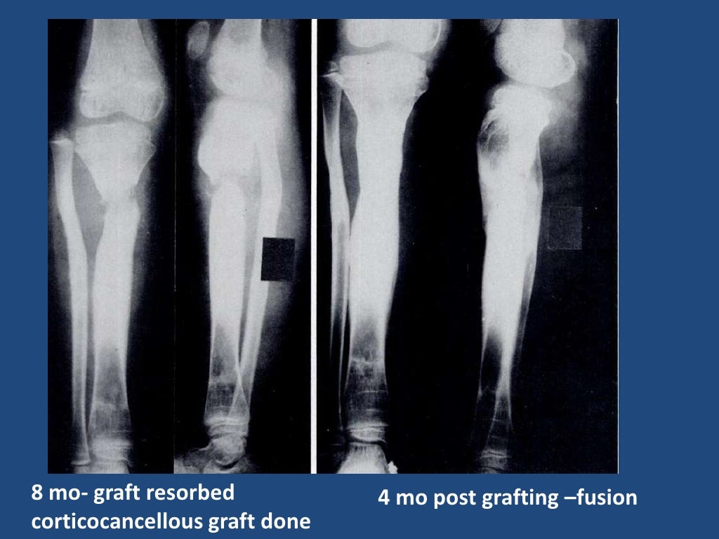 Chronic Osteomyelitis In Children