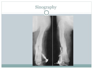 chronicosteomyelitis Powerpt power point | PPTX