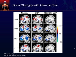 Brain Changes with Chronic Pain
CBP = chronic back pain.
Baliki MN, et al. J Neurosci. 2008;28:1398-1403.
14
 