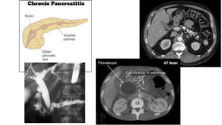 Chronic pancreatitis