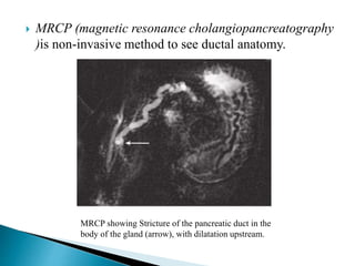  MRCP (magnetic resonance cholangiopancreatography
)is non-invasive method to see ductal anatomy.
MRCP showing Stricture of the pancreatic duct in the
body of the gland (arrow), with dilatation upstream.
 