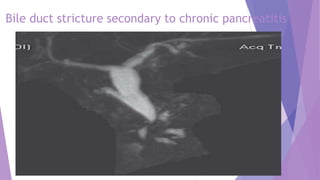 Bile duct stricture secondary to chronic pancreatitis
 