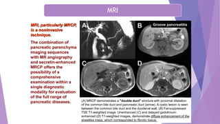 Chronic Pancreatitis
MRI, particularly MRCP,
is a noninvasive
technique.
The combination of
pancreatic parenchyma
imaging sequences
with MR angiography
and secretin-enhanced
MRCP offers the
possibility of a
comprehensive
examination within a
single diagnostic
modality for evaluation
of the full range of
pancreatic diseases. (A) MRCP demonstrates a "double duct" stricture with proximal dilatation
of the common bile duct and pancreatic duct (arrow). A cystic lesion is seen
between the common bile duct and the duodenal wall. (B) Fat-suppressed
TSE T1-weighted image. Unenhanced (C) and delayed gadolinium-
enhanced (D) T1-weighted images, demonstrate diffuse enhancement of the
sheetlike mass, which corresponded to fibrotic tissue.
Groove pancreatitis
MRI
 